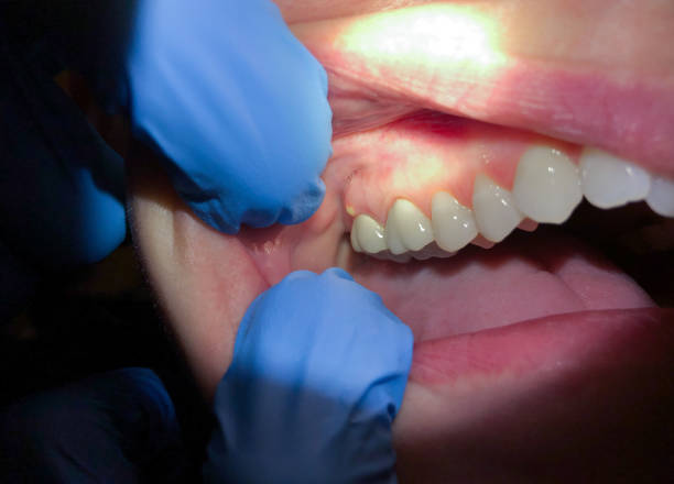 Best Emergency Dentist for Lost Fillings or Crowns in Level Green, PA