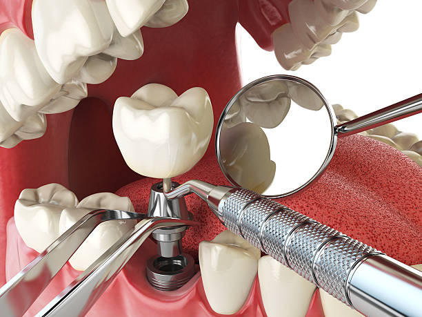 Best Emergency Dentist for Lost Fillings or Crowns in Level Green, PA